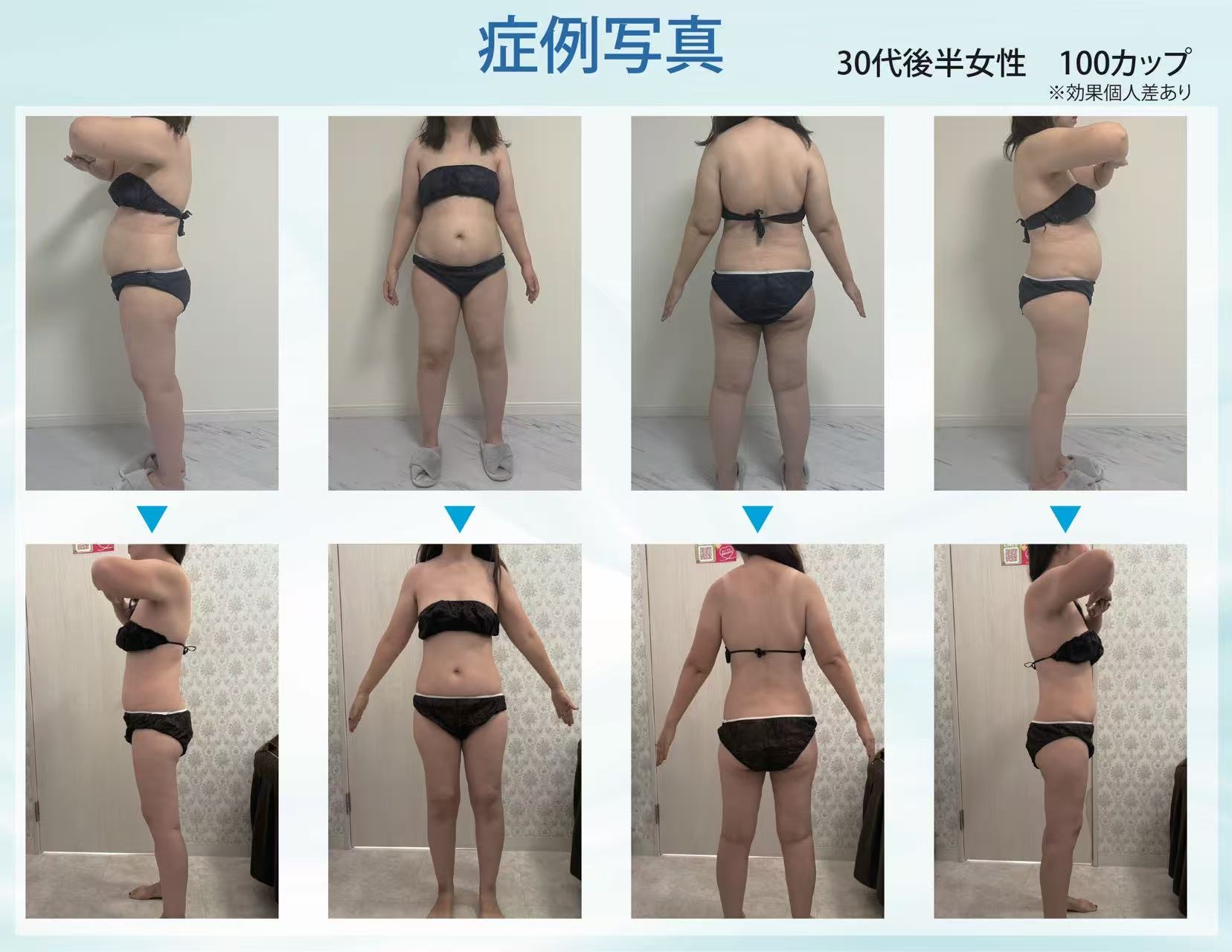 脂肪冷却 継続症例