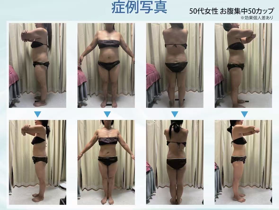脂肪冷却 5回施術