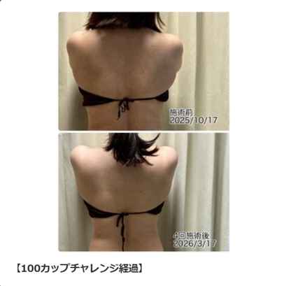 100カップチャレンジ 背中と腰まわりのビフォーアフター症例