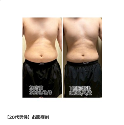 20代男性 お腹症例 正面 before after