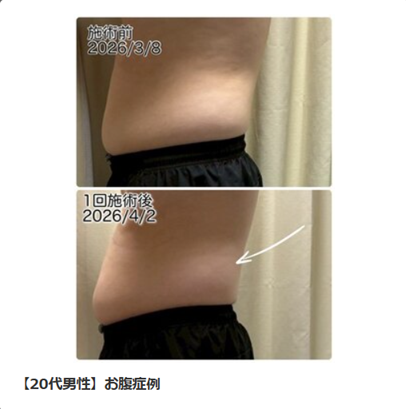 20代男性 お腹症例 側面 before after