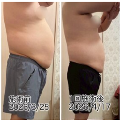 男性 下腹 脂肪冷却 横向き 1回ビフォーアフター