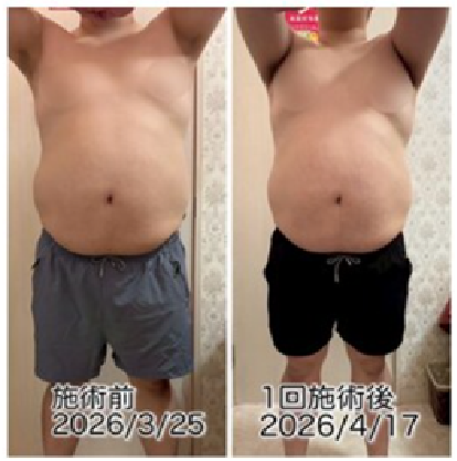 男性 下腹 脂肪冷却 正面 1回ビフォーアフター
