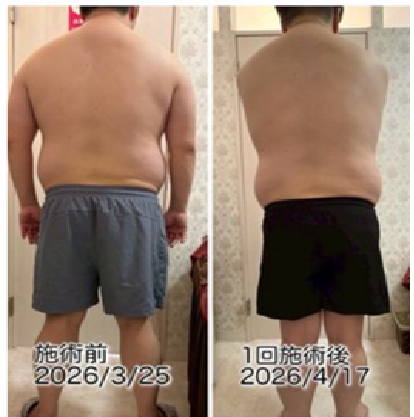 男性 腰肉 背中 脂肪冷却 1回ビフォーアフター